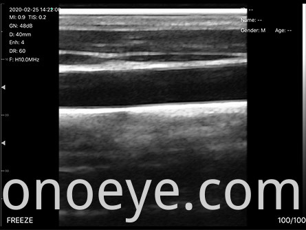 porket ultrasound